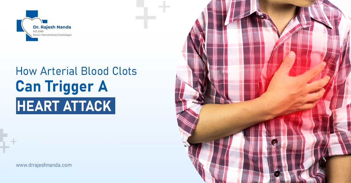 How Arterial Blood Clots Can Trigger a Heart Attack
